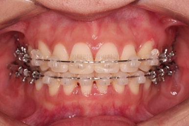 부산사랑니교정