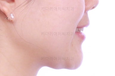 부산인비절라인