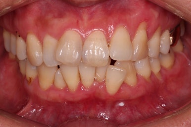 동래임플란트교정