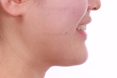 부산치아교정