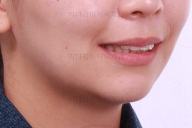 부산사랑니교정