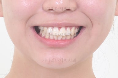 부산사랑니교정