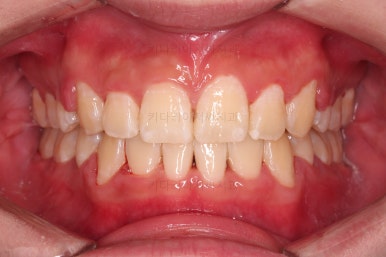 부산돌출입교정