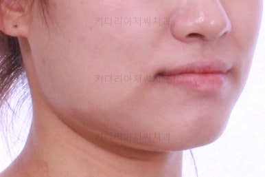 부산치아교정잘하는곳