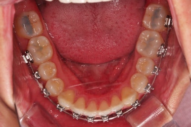 부산연산동치아교정