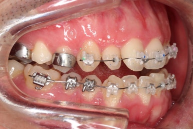 부산긴얼굴긴턱교정