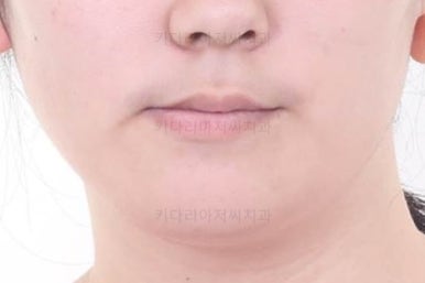 부산구순구개열