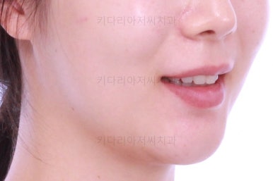 부산부분치아교정