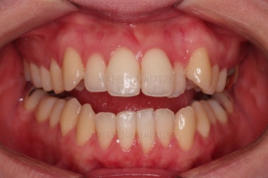 부산치아교정잘하는곳