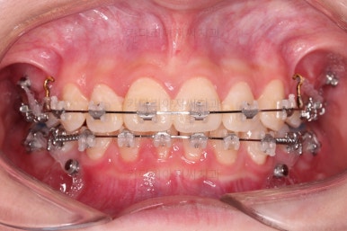 연산동치아교정