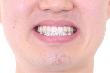 부산비수술교정