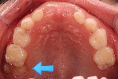부산어린이치아교정