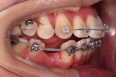 부산치아교정잘하는치과