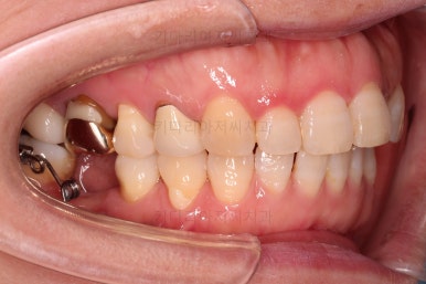 연산동부분교정