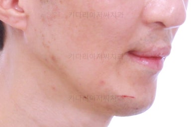 부산구순구개열교정