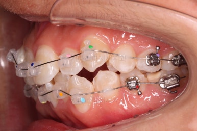 부산청소년치아교정