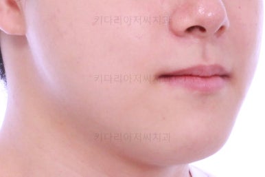 부산주걱턱교정