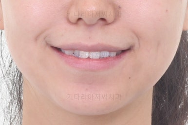 부산교정잘하는치과