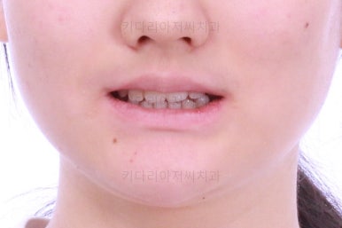 연산동치아교정