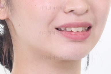 부산돌출입교정