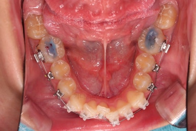 부산비발치교정