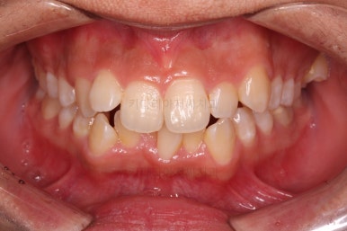 부산청소년치아교정