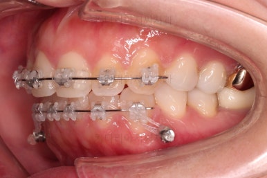 부산부분치아교정