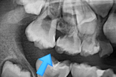 부산어린이치아교정