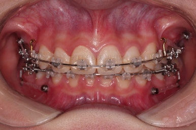 연산동치아교정