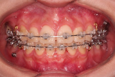 부산클리피씨교정