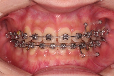 동래구치아교정
