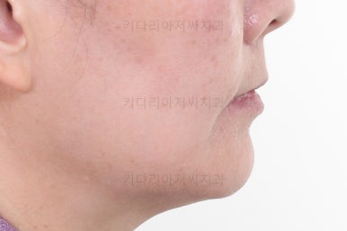 부산옥니교정