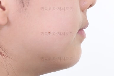 부산토끼치아교정