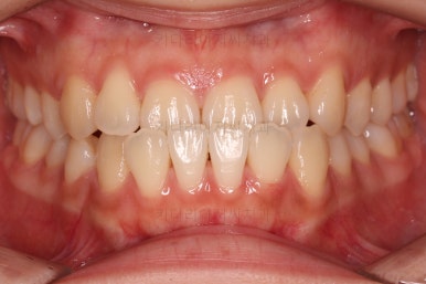 부산치아교정추천