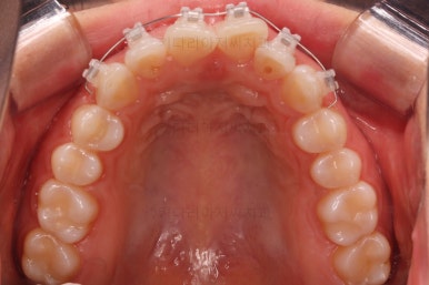 부산나비앞니교정