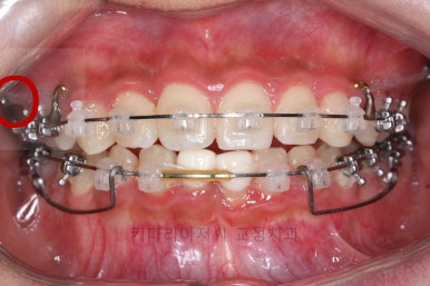 연산동치아교정