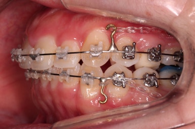 부산비대칭교정