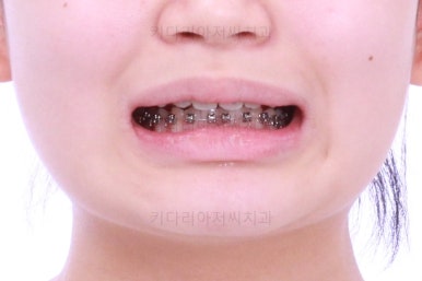 부산어린이치아교정