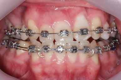 부산구순구개열