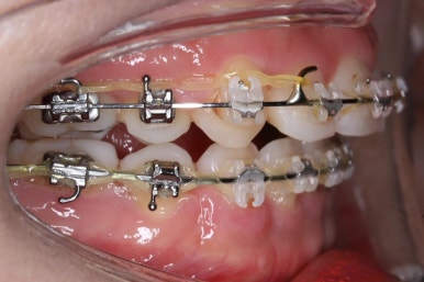 부산연산동교정치과