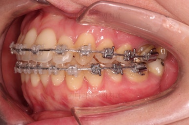 부산치아교정잘하는곳