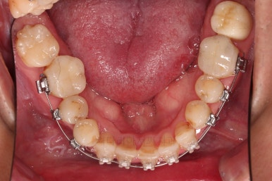 부산구순구개열교정