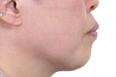 동래임플란트교정