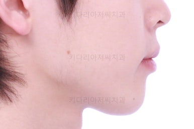 부산돌출입교정