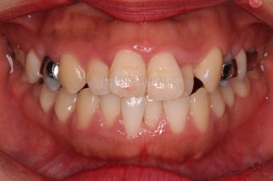 부산비발치교정