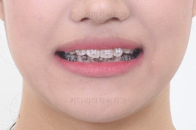 연산동치아교정치과