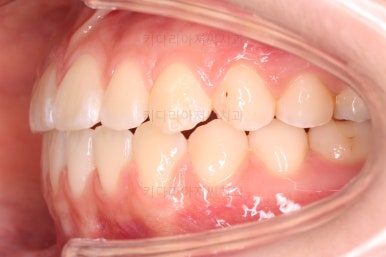 부산치아교정잘하는곳