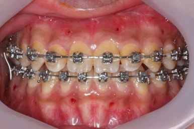 부산주걱턱교정