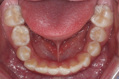 연산동덧니교정