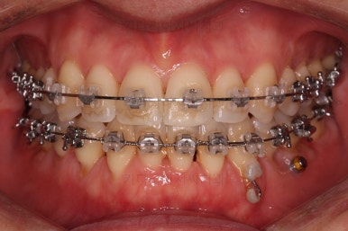 부산비수술교정